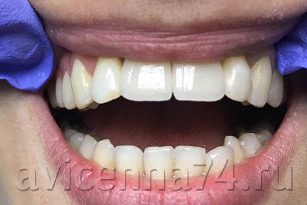 Восстановление утраченных передних зубов
